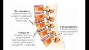 Остеохондроз - дегенерация позвоночника. Часть шестая. Лекции доктора Милованова.