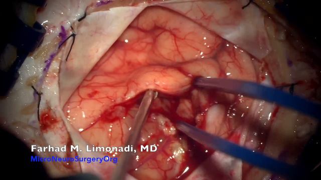 Brain Surgery and removal of Glioblastoma Multiforme GBM malignant brain tumor