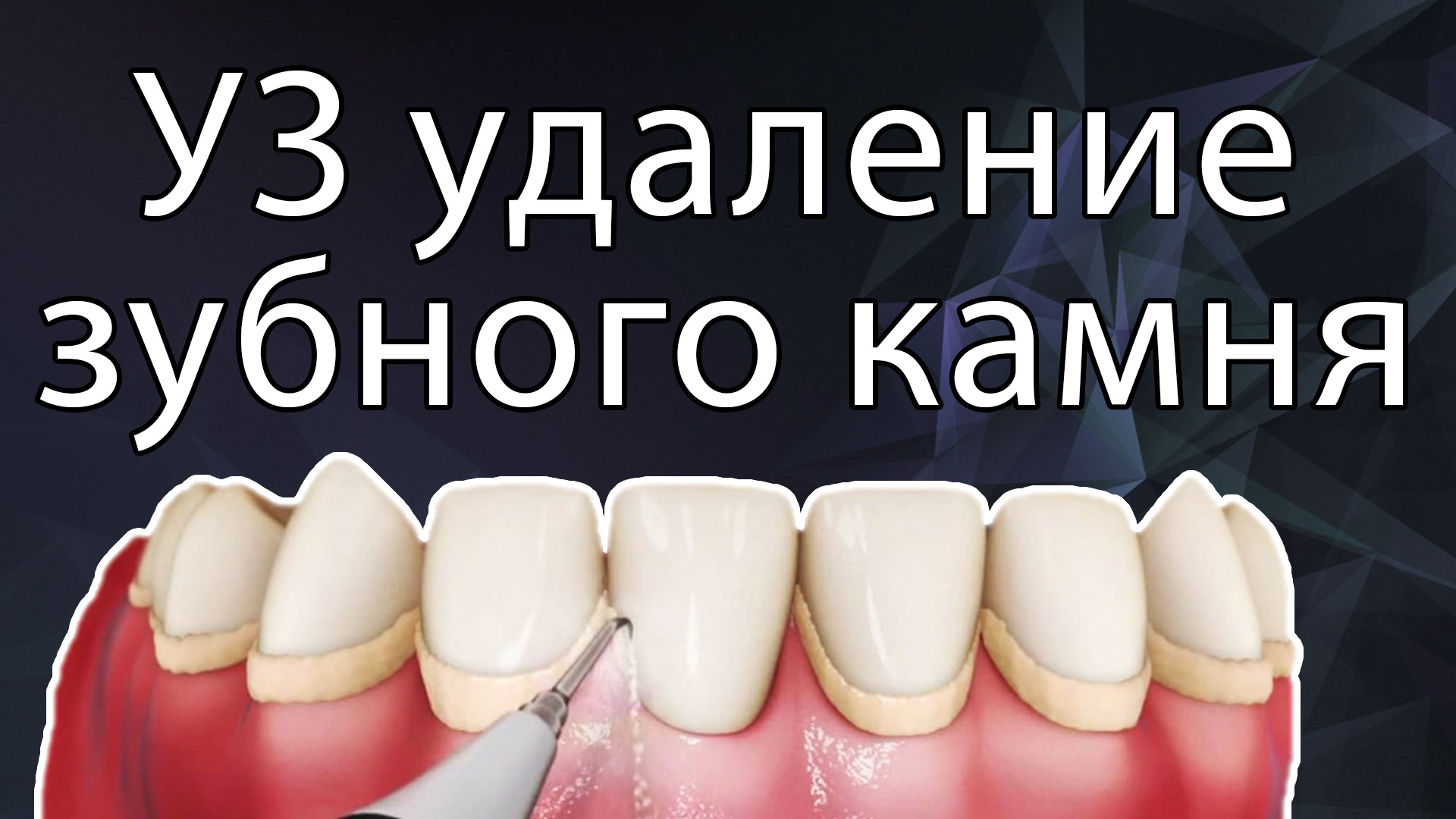 Пескоструйная чистка зубов
