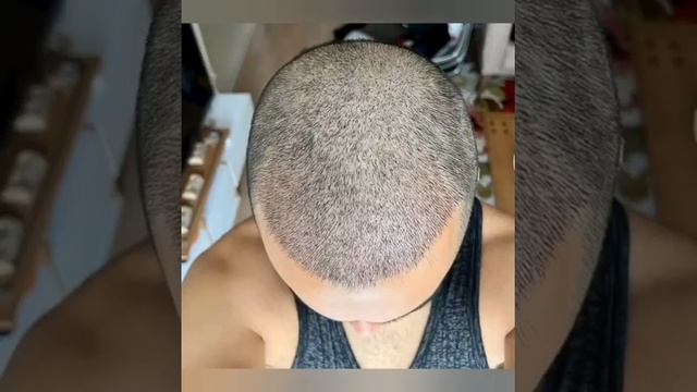 10 days after hair transplant | 10 дней после пересадки волос