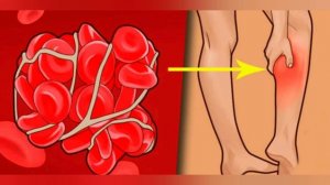 Как растворить тромбы в сосудах народными средствами?
