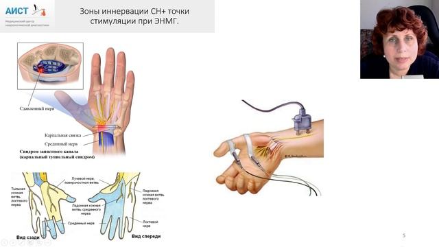 Тема: Миография при карпальном туннельном синдроме.