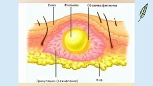 Флегмона
