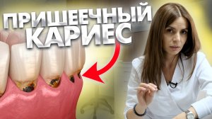 Пришеечный кариес и клиновидный дефект. В чем причины?