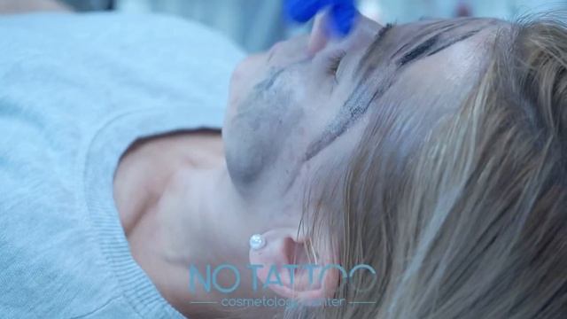 Карбоновый пилинг - обучение в центре лазерной косметологии NO TATTOO #карбоновыйпилинг