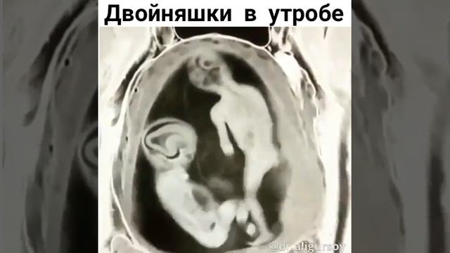 ШОК!!!малыши дерутся в животе смотреть онлайн