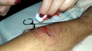 Зашивание раны от циркулярной пилы в домашних условиях/Sewing a wound from a circular saw at home