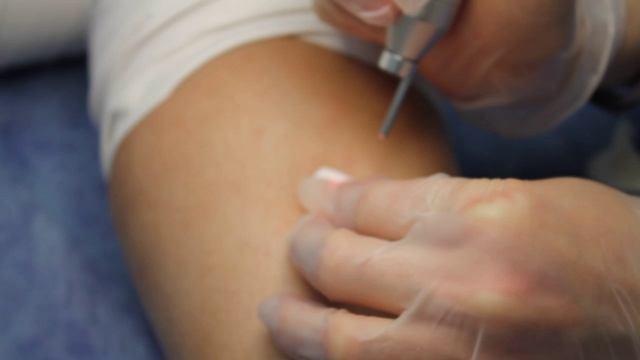 Лазерная деструкция  доброкачественного новообразования на голени