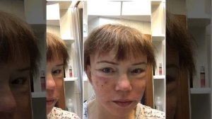 добавлю собственные результаты лазерной шлифовки лица в Фрау Клиник Frau Klinik