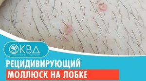 ? Рецидивирующий моллюск на лобке. Клинический случай №924