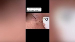 Full blackheads/ ВЫДАВЛИВАНИЕ ОГРОМНЫХ УГРЕЙ/ ЧЕРНЫЕ ТОЧКИ/ УГРИ  ПРЫЩИ ПОДБОРКА/ Pimple Popping