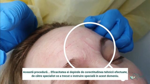 Tehnica blanching cu preparatele Belotero SOFT și BALANCE смотреть онлайн