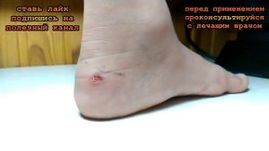 ★ Лечение водяной мозоли. Лечение лопнувшей мозоли-водянки.