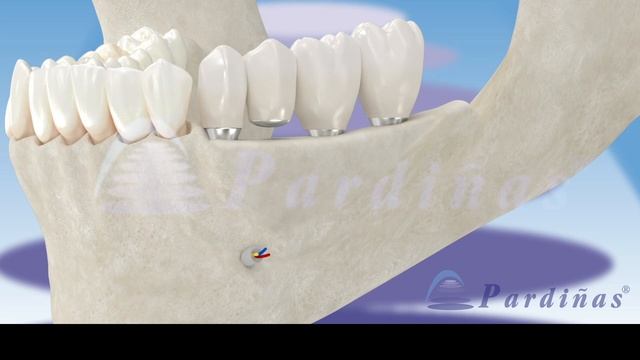 Короткие имплантаты и увеличение высоты альвеолярной кости © смотреть онлайн