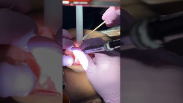 Frenum Release Procedure Clip 1 - JD Dental