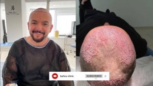 hair transplant in Bellus clinic