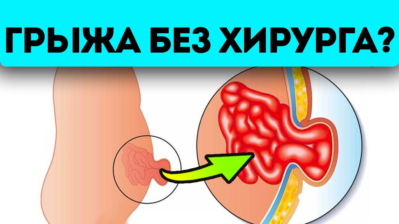 Лечение без операции возможно?! Вот как можно облегчить пупочную грыжу