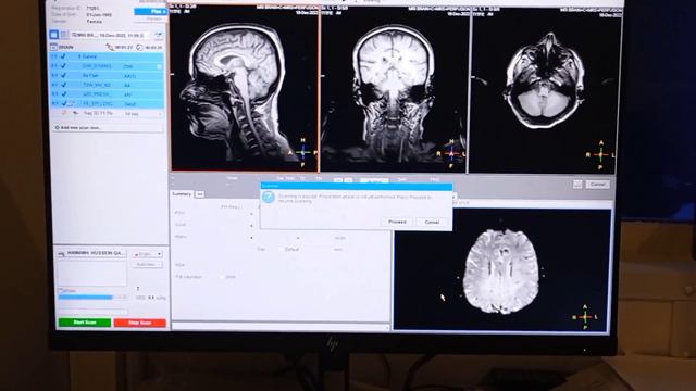 MRI Brain Perfusion planning and post processing on Philips 3T смотреть онлайн