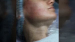 Биоревитализация техникой "10 болюсов" c Basic от PROMOITALIA