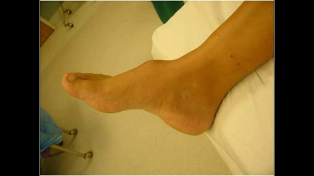 САРКОМА (ЮМШОК ТУКИМАЛАР УСМАСИ САРКОМА) смотреть онлайн