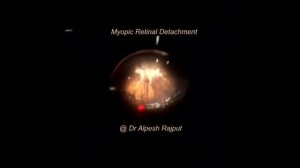 Myopic Retinal detachment