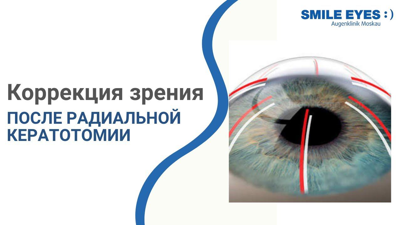 Лазерная коррекция зрения после радиальной кератотомии (насечек на роговице)