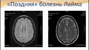 Клещевой боррелиоз