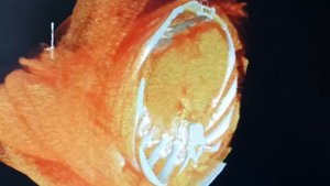 Биопсия подмышечного лимфатического узла