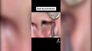 Popping huge blackheads and Pimple Popping - Best Pimple Popping Videos #23