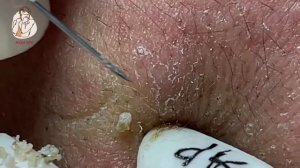 TREATMENT OF BLACKHEADS, HIDDEN ACNE IN THE MOUTH