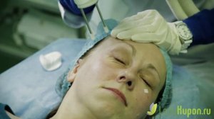 Видеодайджест LadyKupon: Лазерная блефаропластика век