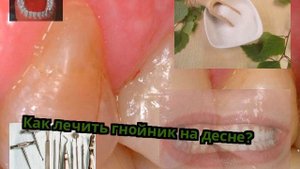 Как лечить гнойник на десне?