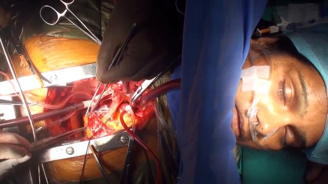 Awake Cardiac Surgery on a patient with "Bombay Blood Group"(Full HD) смотреть онлайн