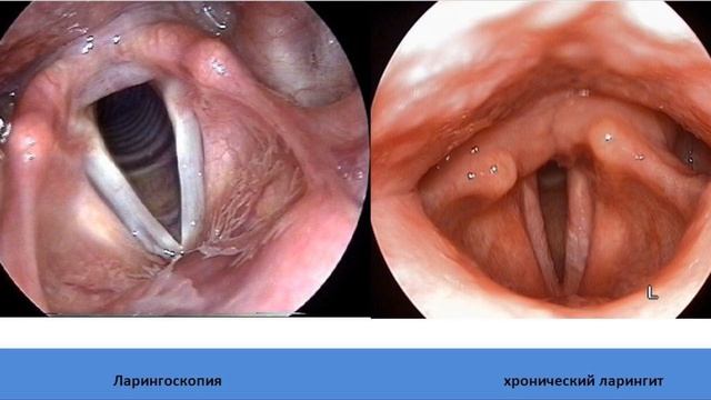 Ларингит симптомы