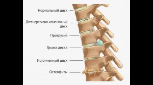 Остеохондроз. Продолжение. Урок 6. Остеофиты. Истонченный диск. Протрузия. Грыжа.