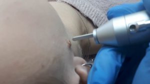 Удаление невуса лазерное