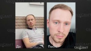 Пересадка волос в России, Москва. Результаты пациентов сделавших пересадку волос в Географт/GeoGraf