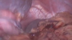 Бариатрическая хирургия/Продольная "рукавная"резекция желудка