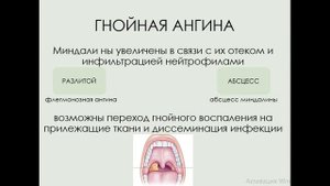 АНГИНА (ТОНЗИЛЛИТ). ПРИЧИНЫ, МЕХАНИЗМ РАЗВИТИЯ, ПАТОЛОГИЧЕСКАЯ АНАТОМИЯ, ОСЛОЖНЕНИЯ.