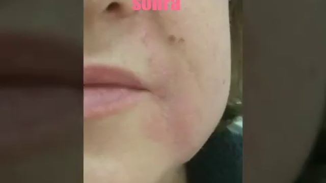 Hifu smas lifting HIFU SMAS LİFTİNG ( by Rena Rzayeva təqdim edir ) смотреть онлайн