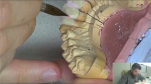 Нанесение керамики emax  на диоксид циркония каркас  Нанесение из 6 масс