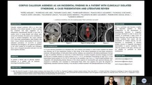 CORPUS CALLOSUM AGENESIS AS AN INCIDENTAL FINDING IN A PATIENT WITH CLINICALLY ISOLATED SYNDROME.