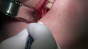 Открытый синус-лифтинг