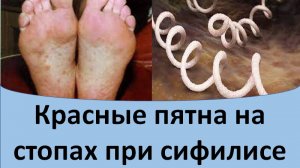 Красные пятна на стопах при сифилисе.