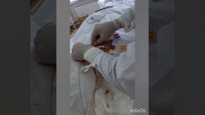 ИМПЛАНТАЦИЯ ПЕРМАНЕНТНОГО КАТЕТЕРА ДЛЯ ГЕМОДИАЛИЗА.