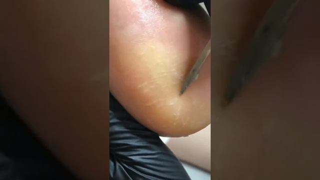 Препаратный педикюр KART (Израиль), подолог Екатерина Зимина (Москва/Саранск) смотреть онлайн