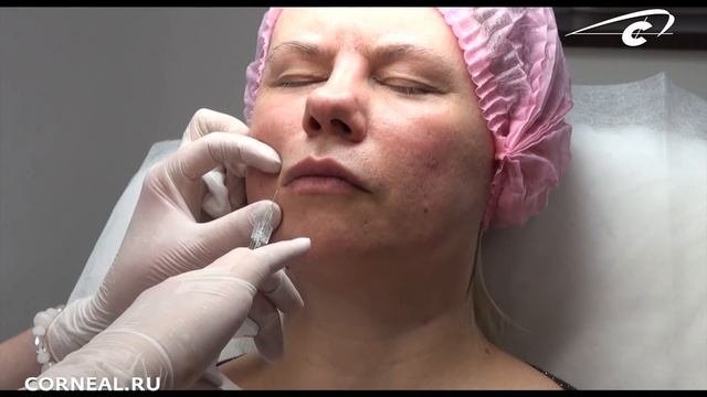 Три техники введения. Контурная пластика