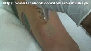 Удаление татуировок лазером. Tattooentfernung YAG Laser Gerät LM3