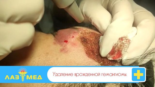 Удаление врождённой гемангиомы