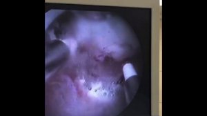 Резекция субмукозного узла миомы матки, тип 0